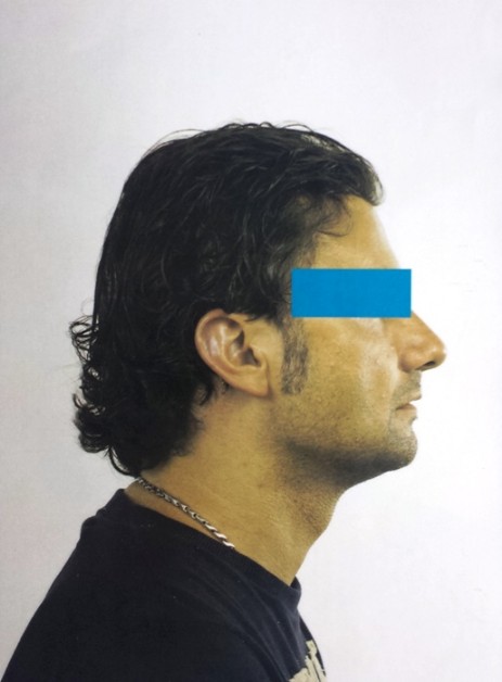 Protesi per capelli Protesi per capelli