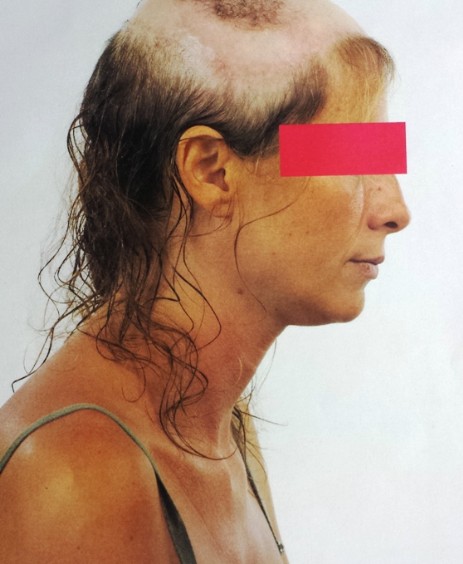 Protesi per capelli Protesi per capelli