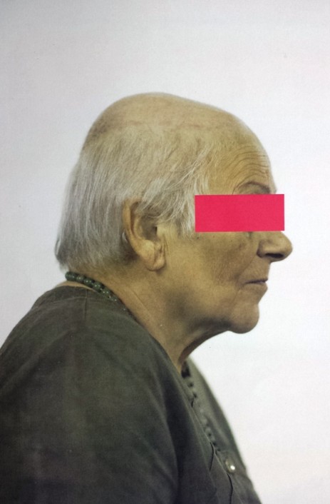 Protesi per capelli Protesi per capelli