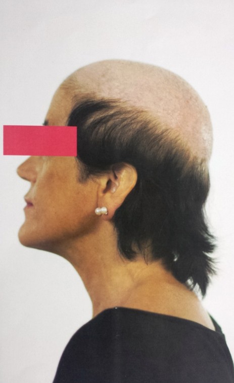 protesi per capelli protesi per capelli