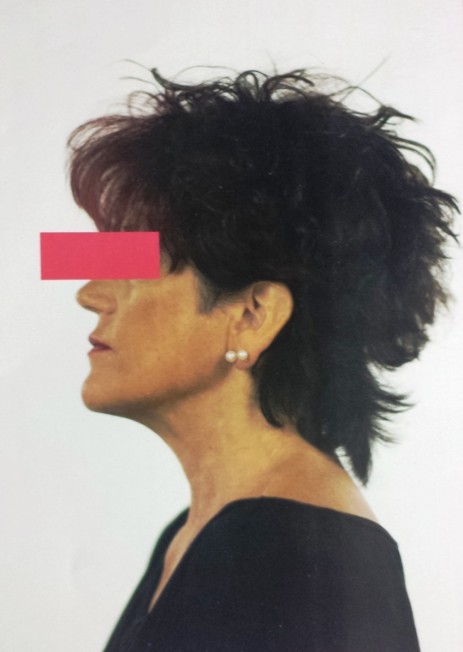 protesi per capelli protesi per capelli