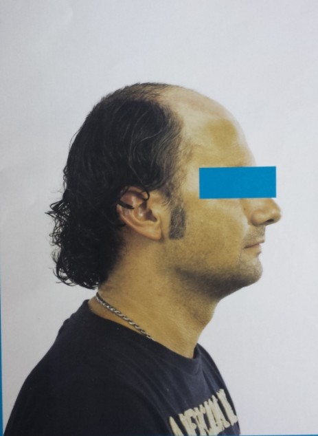 Protesi per capelli Protesi per capelli
