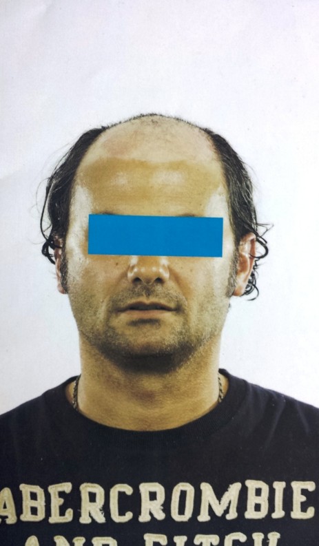Protesi per capelli Protesi per capelli