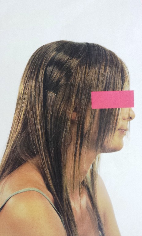 Protesi per capelli Protesi per capelli