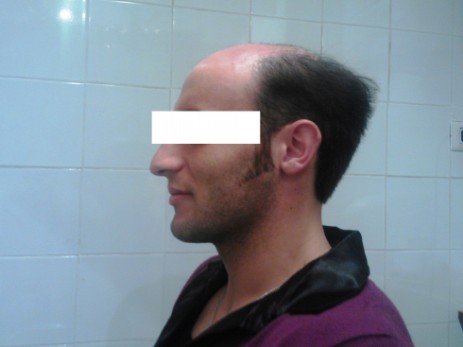Protesi per capelli Protesi per capelli