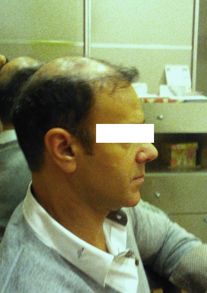 protesi per capelli protesi per capelli