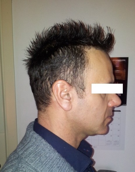 protesi per capelli protesi per capelli
