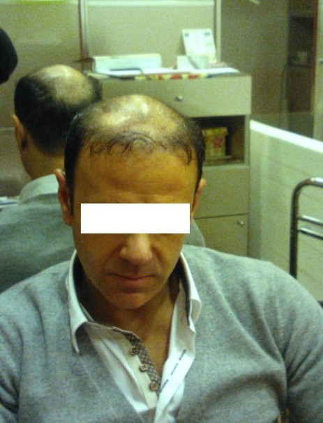 protesi per capelli protesi per capelli