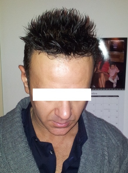 protesi per capelli protesi per capelli