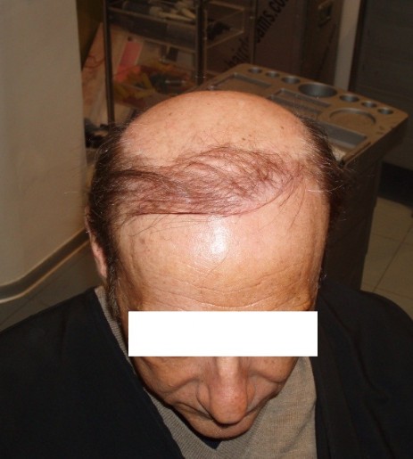 protesi per capelli