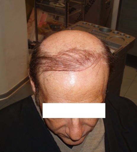protesi per capelli protesi per capelli