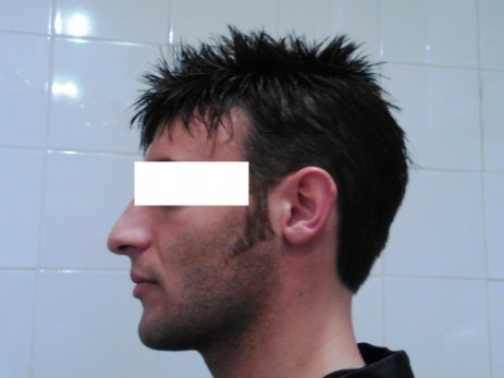 Protesi per capelli Protesi per capelli