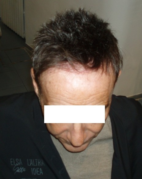 protesi per capelli protesi per capelli