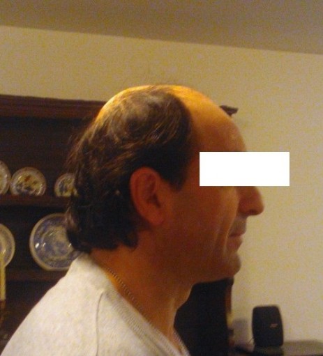 protesi per capelli