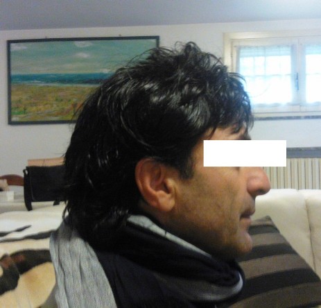 protesi per capelli protesi per capelli