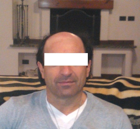 protesi per capelli protesi per capelli
