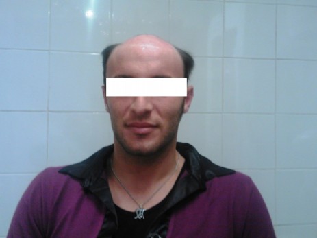 protesi per capelli protesi per capelli