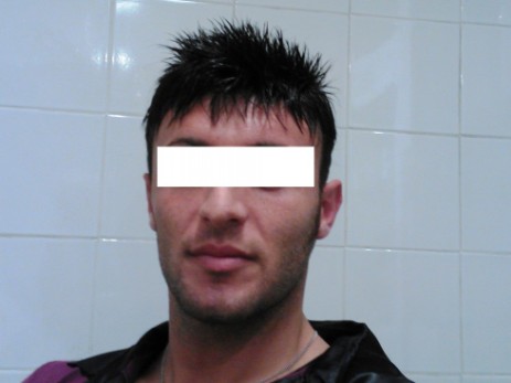 protesi per capelli protesi per capelli