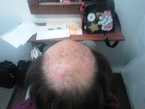 protesi per capelli protesi per capelli