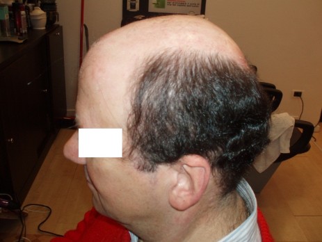protesi per capelli protesi per capelli
