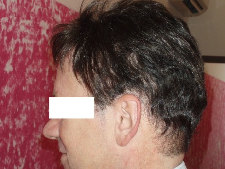 protesi per capelli protesi per capelli