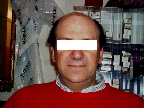 protesi per capelli protesi per capelli
